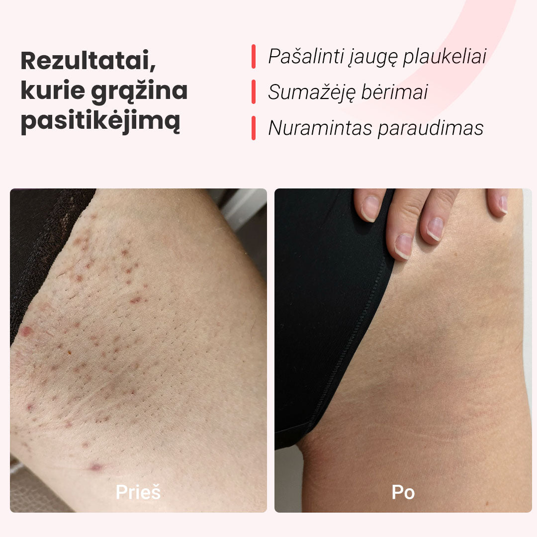 IPL fotoepiliatorius - odoscentras.lt
